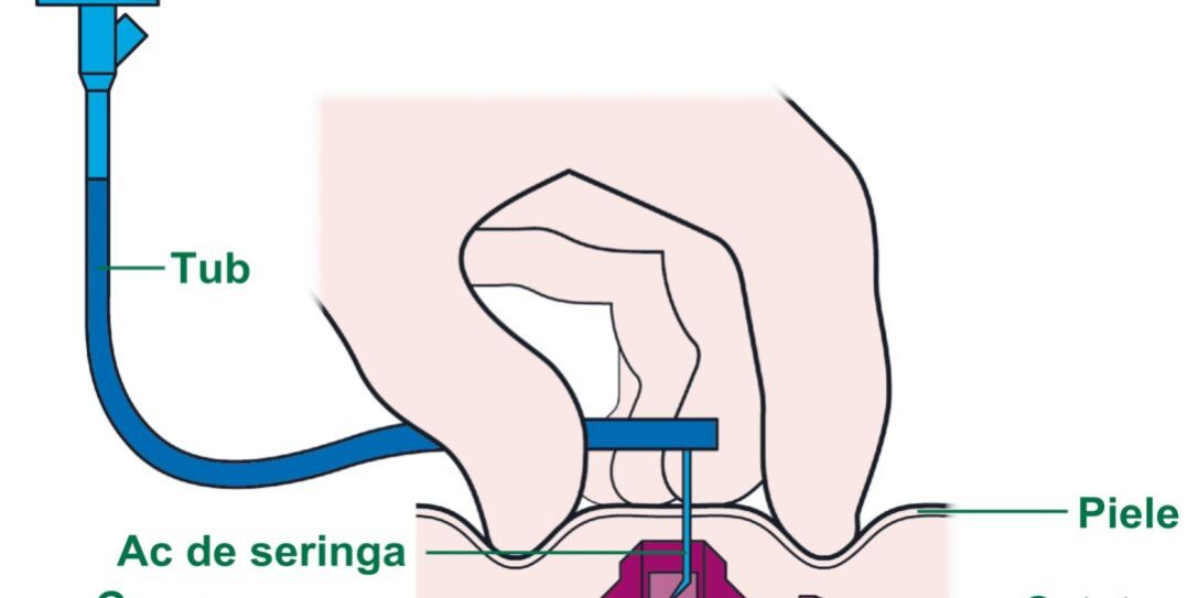 camere-implantabile